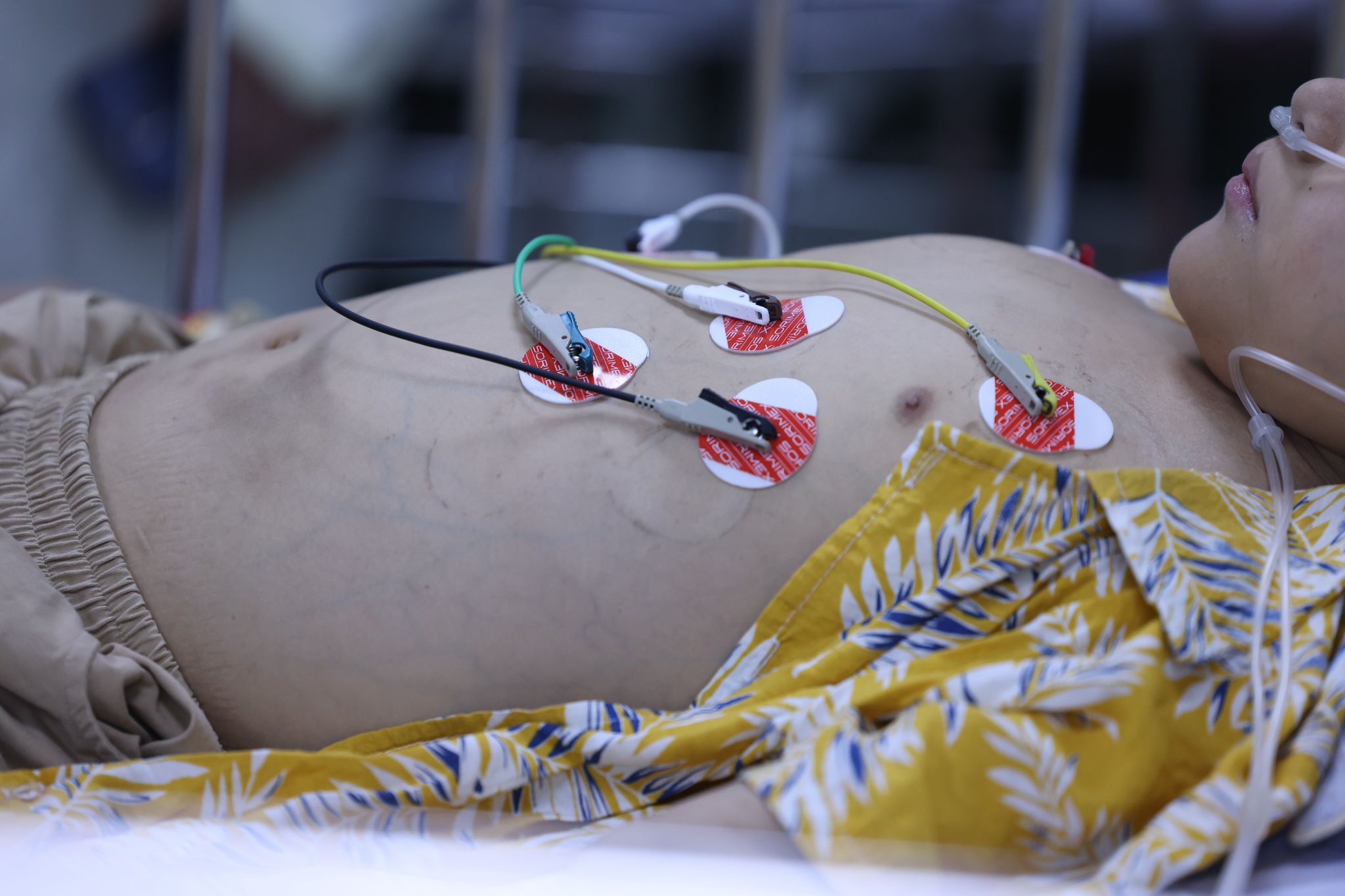 sốt xuất huyết ảnh 13 sot xuat huyet anh 13