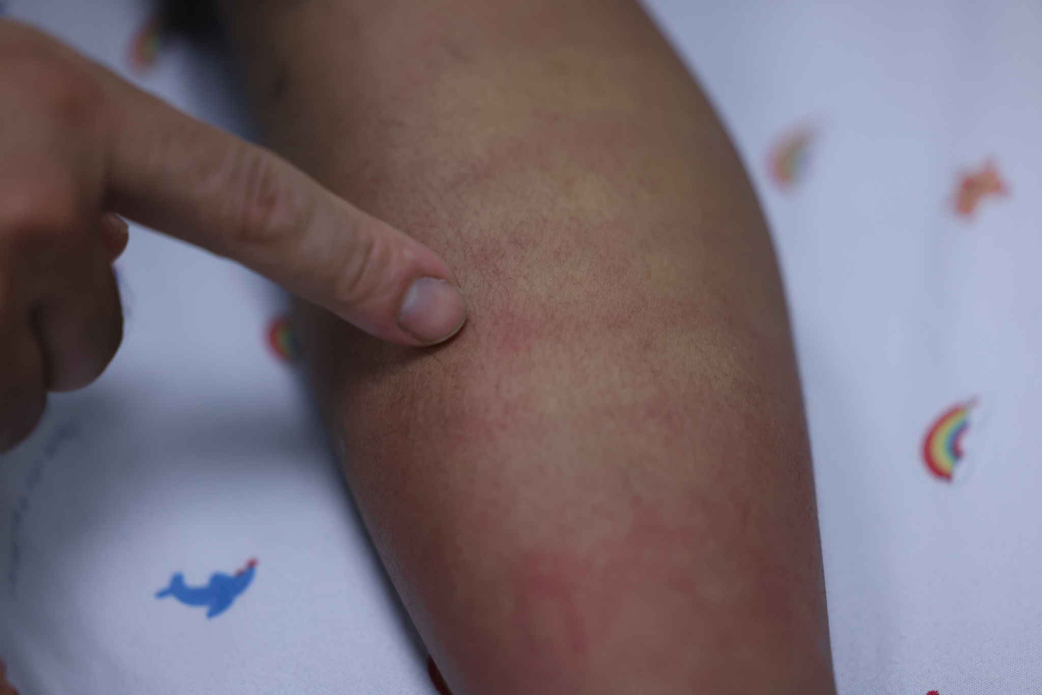 sốt xuất huyết ảnh 9 sot xuat huyet anh 9