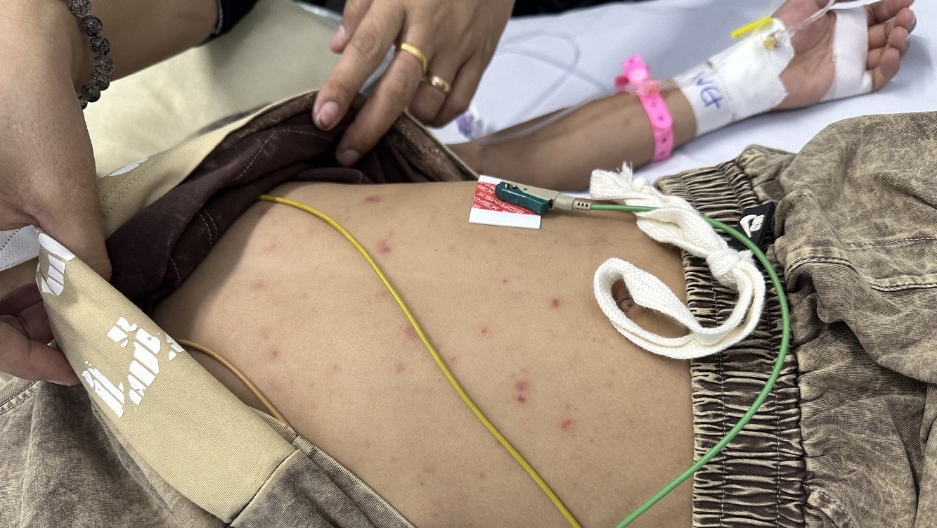 Vaccine n&atilde;o m&ocirc; cầu ảnh 2
