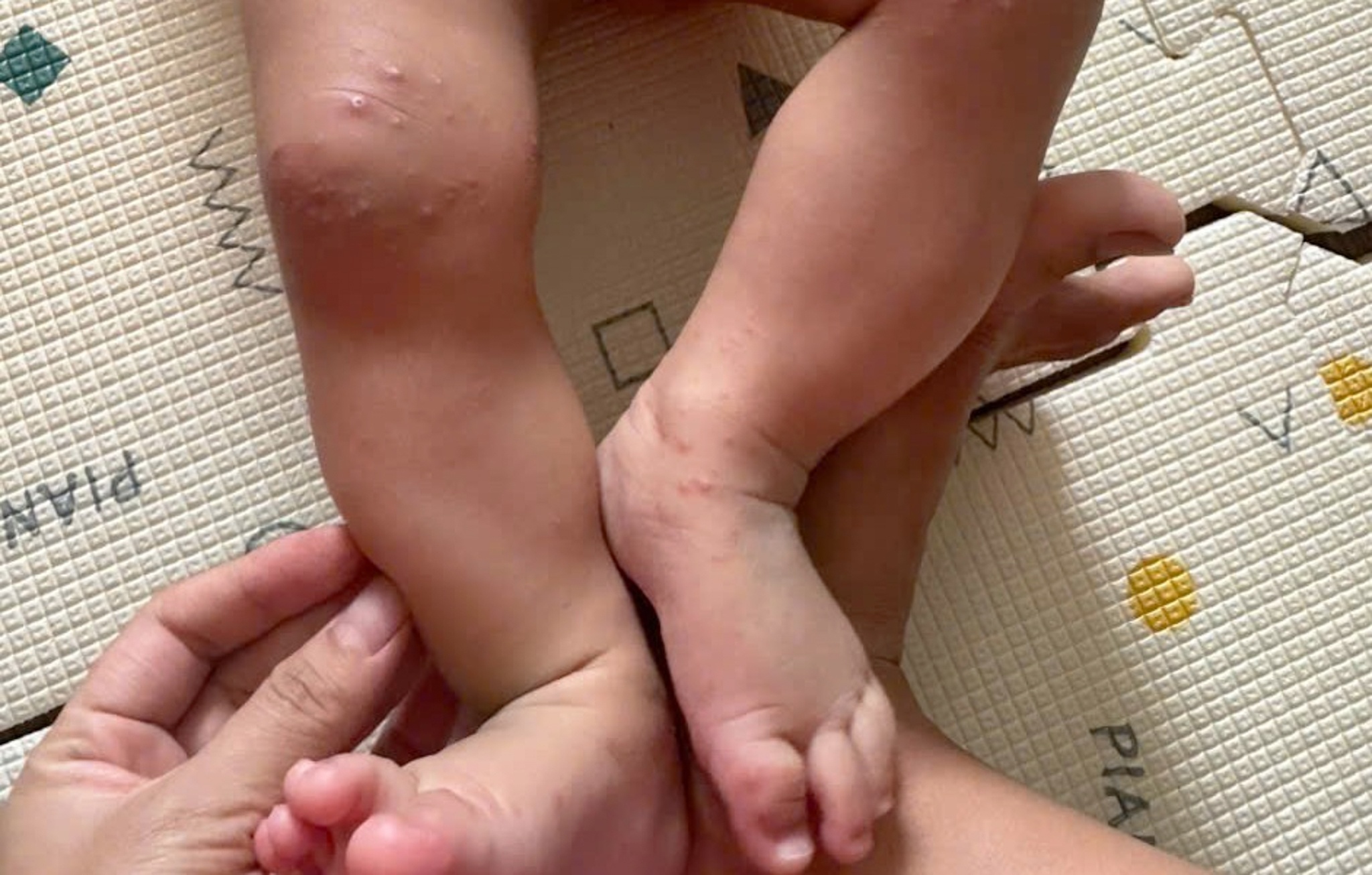 Vaccine tay chân miệng ảnh 3 Vaccine tay chân miệng ảnh 3