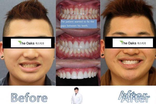 xu hướng phẫu thuật thẩm mỹ ảnh 8 xu huong phau thuat tham my anh 8