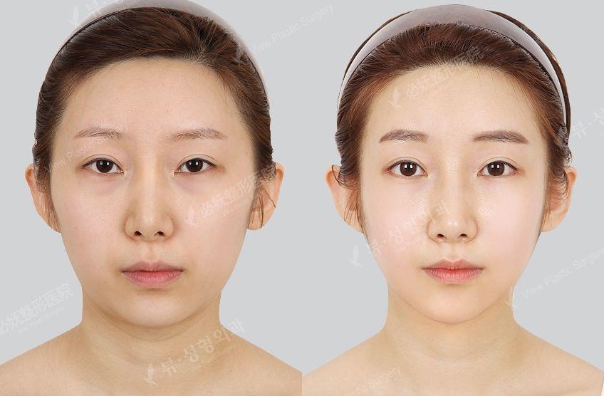 xu hướng phẫu thuật thẩm mỹ ảnh 3 xu huong phau thuat tham my anh 3