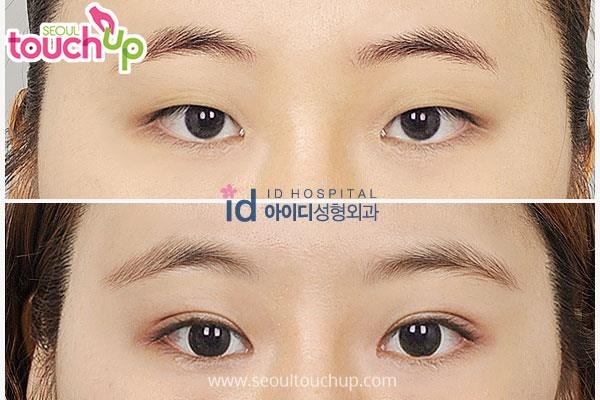 xu hướng phẫu thuật thẩm mỹ ảnh 1 xu huong phau thuat tham my anh 1