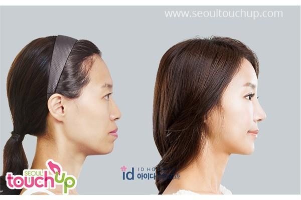 xu hướng phẫu thuật thẩm mỹ ảnh 5 xu huong phau thuat tham my anh 5