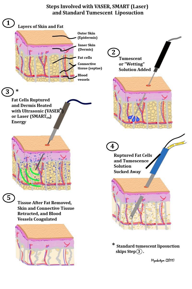 Phau thuat bung 6 mui anh 2