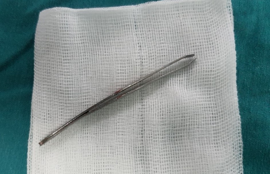 Cay nhip dam tu mieng len mui be trai 10 tuoi hinh anh