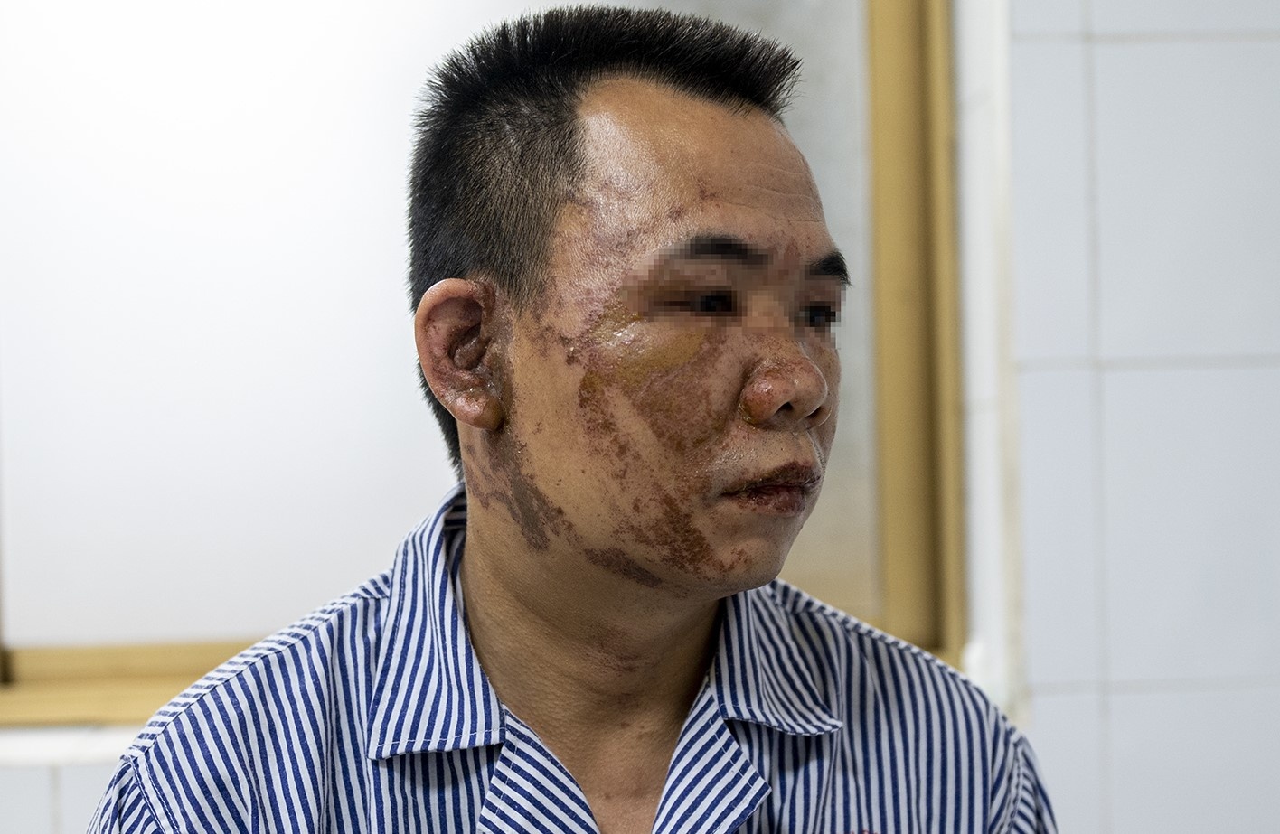 Loi ke cua nguoi dan ong bi tat axit sau cuoc cai va hinh anh