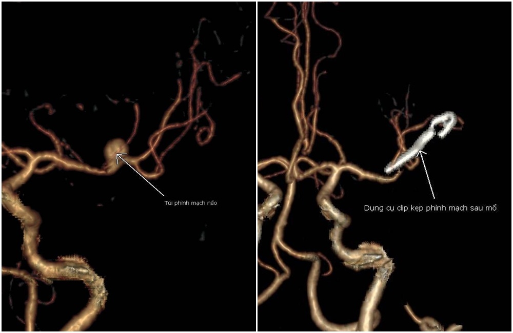 xuất huyết não,  bệnh viện,  bệnh viện đa khoa tỉnh Quảng Ninh,  Quảng Ninh,  bác sĩ,  phẫu thuật thần kinh ảnh 1 xuat huyet nao,  benh vien,  benh vien da khoa tinh Quang Ninh,  Quang Ninh,  bac si,  phau thuat than kinh anh 1