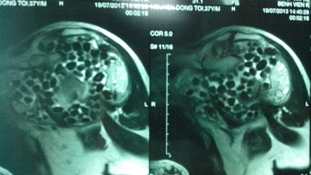 300 hat soi trong khop vai mot benh nhan hinh anh