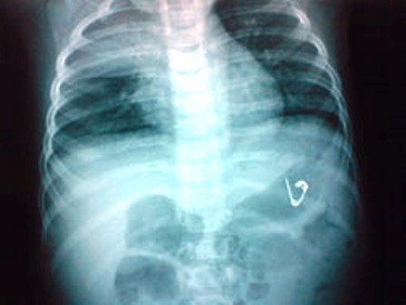 Be 6 thang tuoi nuot kim bang 2 cm hinh anh