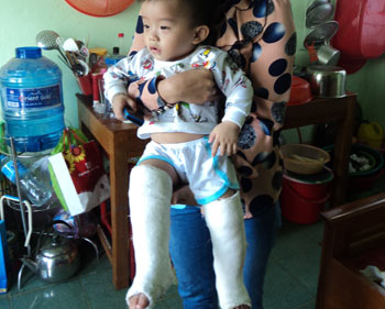 Don con o nha tre ve thay gay ca 2 chan hinh anh