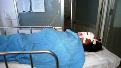 Cuu song benh nhan bi xa beng dam xuyen dau hinh anh