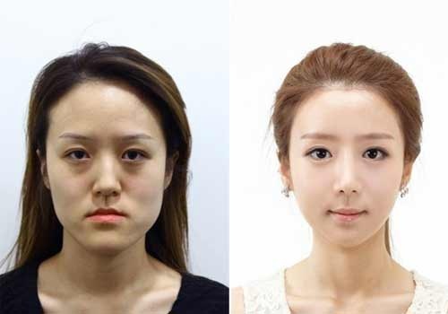 Chi em song sinh hoa 'thien nga' sau phau thuat tham my hinh anh