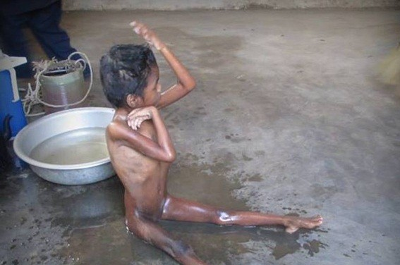 Hinh anh co be 'nguoi rung' vua duoc phat hien o Khanh Hoa hinh anh