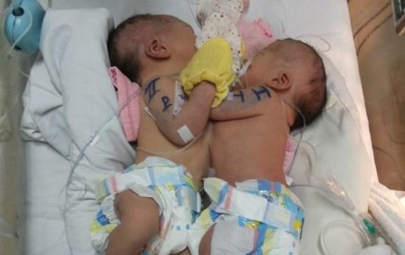 Tach thanh cong 2 be song sinh dinh nhau o Sai Gon hinh anh