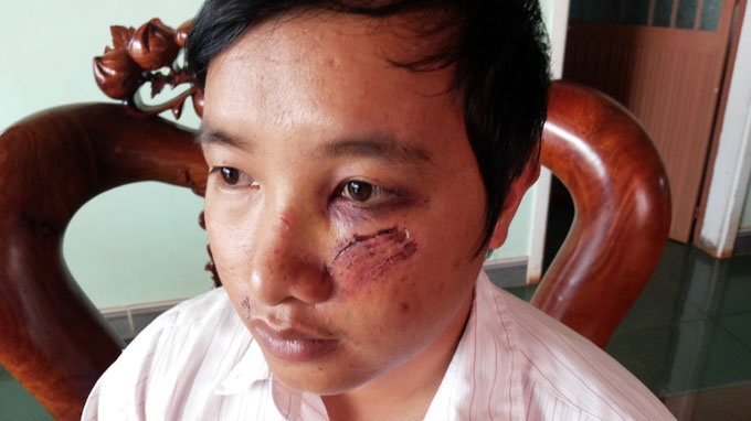 Lam ro vu mot thay giao bi danh phai nhap vien hinh anh