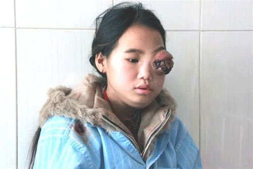 Co be nguoi Mong bi benh u mat nguy hiem hinh anh