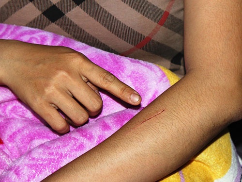 Dau dau vi nan rach mong hinh anh