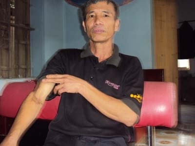 Ông Bùi Văn Vi hơn 50 năm theo nghề và những vết thương còn đọng lại trên tay ông.