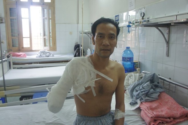 Bi cua mat tay vi nga vao bep than khi len con dong kinh hinh anh