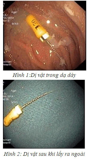 Dị vật trong dạ dày bé.