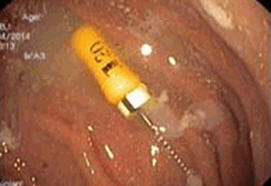 Di chua rang be trai 4 tuoi nuot phai kim nhon hinh anh