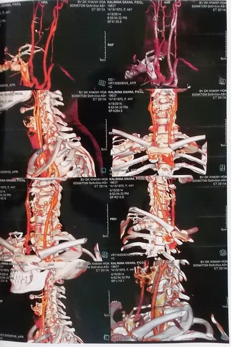Ảnh chụp MSCT vùng cột sống cổ bị chấn thương.