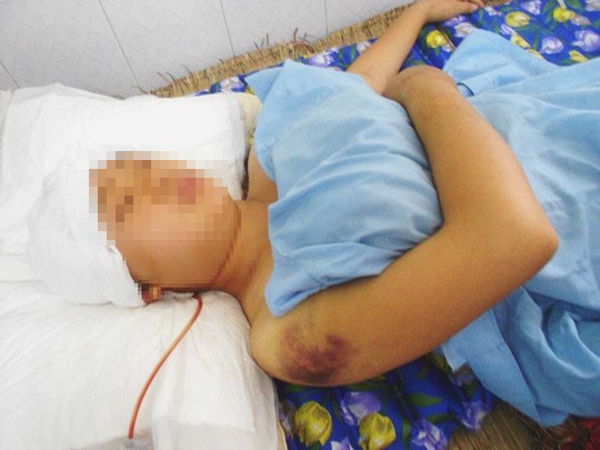 Chiều ngày 9-5, bác sĩ Trần Văn Thiết - Trưởng khoa phẫu thuật thần kinh lồng ngực, Bệnh viện Đa Khoa tỉnh Thanh Hóa, -cho biết bệnh viện đang điều trị một ca bị thương nặng do nạn nhân bị bố chồng chém nhiều nhát vào đầu và tay, mất nhiều máu và nguy hiểm đến tính mạng nếu không được cấp cứu kịp thời.  Trước đó vào khoảng 15 giờ ngày 6-5, do mâu thuẫn trong gia đình từ trước nên chị V.T.M. (SN 1991, ngụ xã Yên Phong, huyện Yên Định, tỉnh Thanh Hóa) đã bị bố chồng chém tới 10 nhát dao vào đầu và tay khiến nạn nhân bị thương nặng.   Rất nhiều người dân chứng kiến đã lao vào can ngăn và cùng gia đình nạn nhân nhanh chóng cầm máu rồi đưa chị M. tới Bệnh viện Đa khoa huyện Yên Định để cấp cứu. Đến chiều tối cùng ngày, chị M. đã phải chuyển lên Bệnh viện Đa Khoa tỉnh Thanh Hóa để điều trị do vết thương quá nặng.  Tại bệnh viện, qua phẫu thuật, kiểm tra các bác sỹ chuẩn đoán, nạn nhân bị hở sọ não, máu tụ ngoài màng cứng, máu tụ dưới màng cứng, vỡ lún xương sọ phức tạp.  “Khoảng 18 giờ 30 phút ngày 6-5, chị M. được chuyển tới bệnh viện trong tình trạng hôn mê, da mặt nhợt nhạt, máu chảy nhiều do bị thương ở vùng đầu, tay. Ngay sau đó, nạn nhân được mổ phẫu thuật cắt xương sọ, lấy máu tụ ngoài và dưới màng cứng. Hiện sức khỏe chị M. đã ổn định, tuy nhiên phải 3 tháng sau khi sức khỏe tốt, chị M. mới được cấy ghép lại xương sọ” - bác sĩ Thiết cho biết.  Được biết, chị M. mới sinh một bé trai được 9 ngày, chồng đi làm ăn ở nước ngoài, nên giữa chị và gia đình có mâu thuẫn và bị bố chồng chém dã mam.  Sau khi chém con dâu trọng thương, bố chồng của chị M. đã bị công an tạm giữ để điều tra, làm rõ vụ việc.
