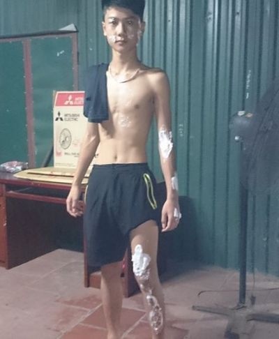 Một người đi đường bị bỏng do a xít trong xe tải bắn ra ngoài.