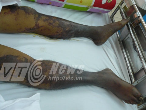 Một bệnh nhân nhiễm viêm cầu khuẩn lợn.