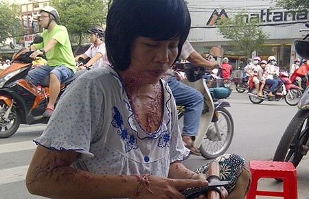 Nguoi giu xe ngheo bi tat axit hinh anh