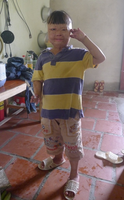 Từ một đứa trẻ kháu khỉnh, khỏe mạnh, cháu Vũ Quốc Linh (SN 2008, trú tại xã Tế Tân, huyện Nông Cống, Thanh Hóa) bỗng chốc trở thành tàn tật bởi người cha độc ác. Theo đó, ngày 27/4/2011, Vũ Văn Quang (bố cháu Linh) trong lúc tức giận vợ đã mua xăng tẩm vào người đứa con ruột mới hơn 3 năm tuổi, rồi châm lửa đốt.