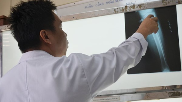 Sau khi thực hiện kéo dài xương thành công cho nhiều người bị bệnh lý, kéo dài xương thẩm mỹ cũng được nhiều người thích làm.