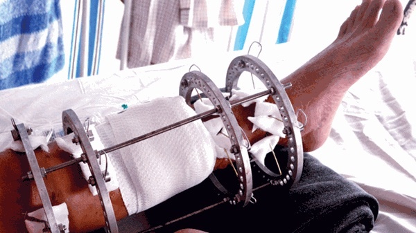 Chiu cuc hinh keo xuong de co chan dai tai TP.HCM hinh anh