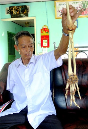 Ông Hùng và cánh tay của chính mình.