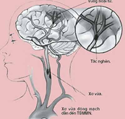 Can thiep kip thoi benh nhan bi xo vua dong mach canh hinh anh