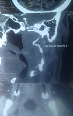 Hình chụp MSCT 64 hẹp rất nặng động mạch cảnh trong trái.