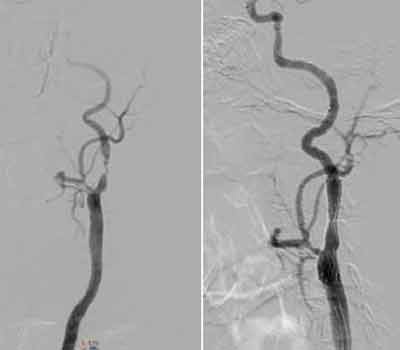 Hình ảnh chụp mạch máu động mạch cảnh hẹp nặng trước và kết quả sau đặt stent động mạch cảnh.