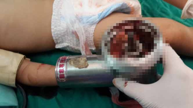 Ban tay tre em bi cuon vao may xay thit hinh anh