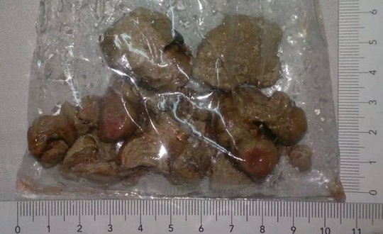 Lay vien soi to hiem gap trong than nu benh nhan hinh anh