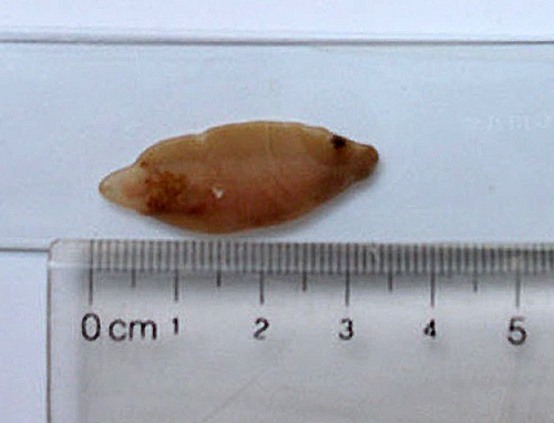 San la gan bo khap co the benh nhan hinh anh