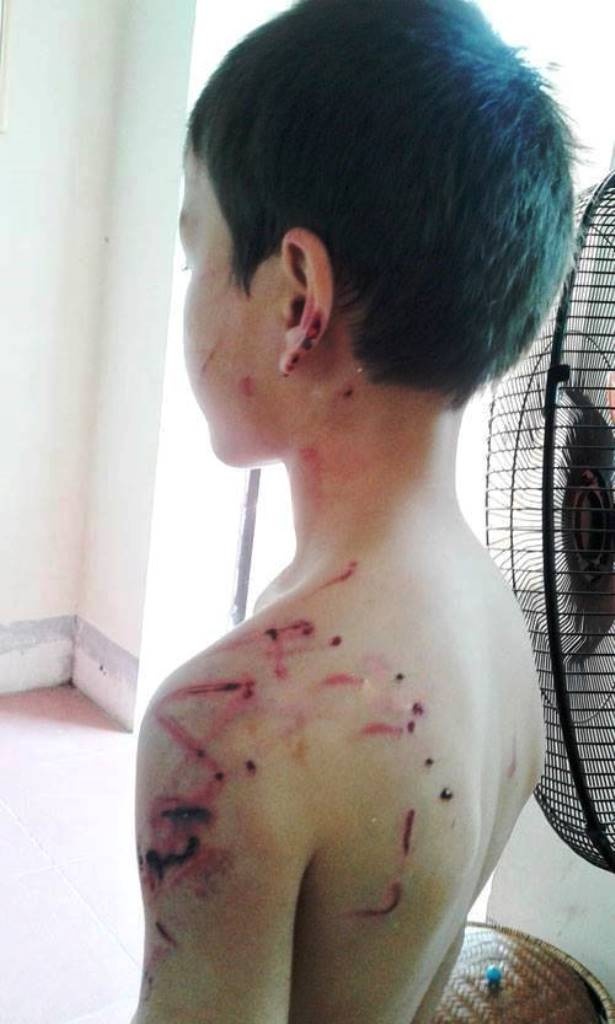 Vết thương bầm tím chi chít trên người cháu Nam. Ảnh: Lê Nam.