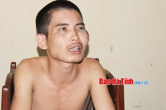 Trước khi giết người, Xuân đã bị ngã xe máy sưng cả mắt.