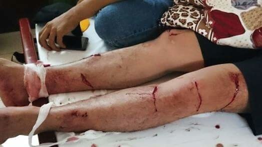 Một cascadeur mang thương tích sau khi bị hành hung.