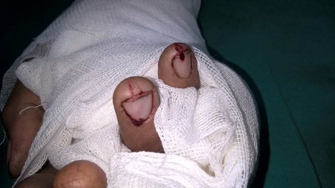 No banh xe khi bom, mot nguoi dut gan lia ngon tay hinh anh