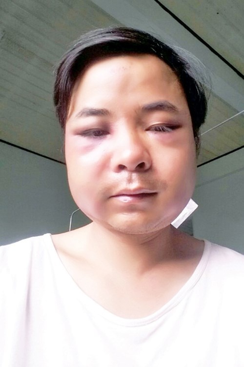 Mặt anh Hà bị đánh sưng vù.