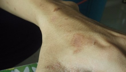 Lo loet vi bi kien ba khoang lien tuc tan cong hinh anh