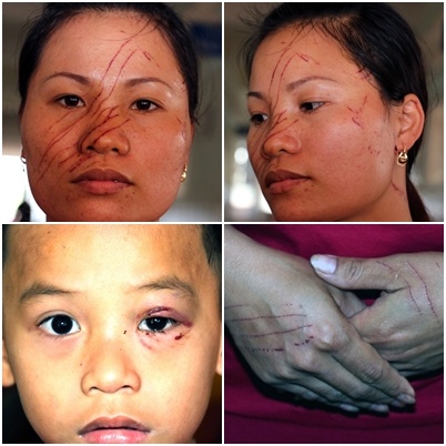 Hai mẹ con chị Tường Vân bị đánh và rạch dao lam khắp người.