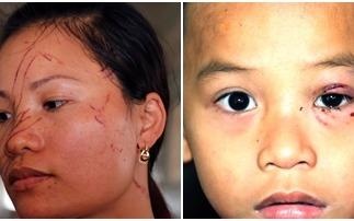 Hai me con bi hang xom danh, dung dao lam rach mat hinh anh