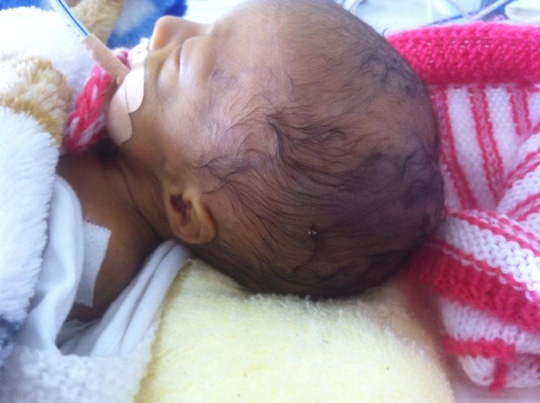 Nghi van vet khau tren dau be so sinh hinh anh